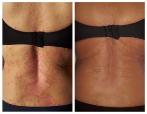 Das Bild der Rückenpartie von Frau Meyer zeigt die Verbesserung des Hautbildes durch die Dermacell Psoriasis Kur besonders deutlich.